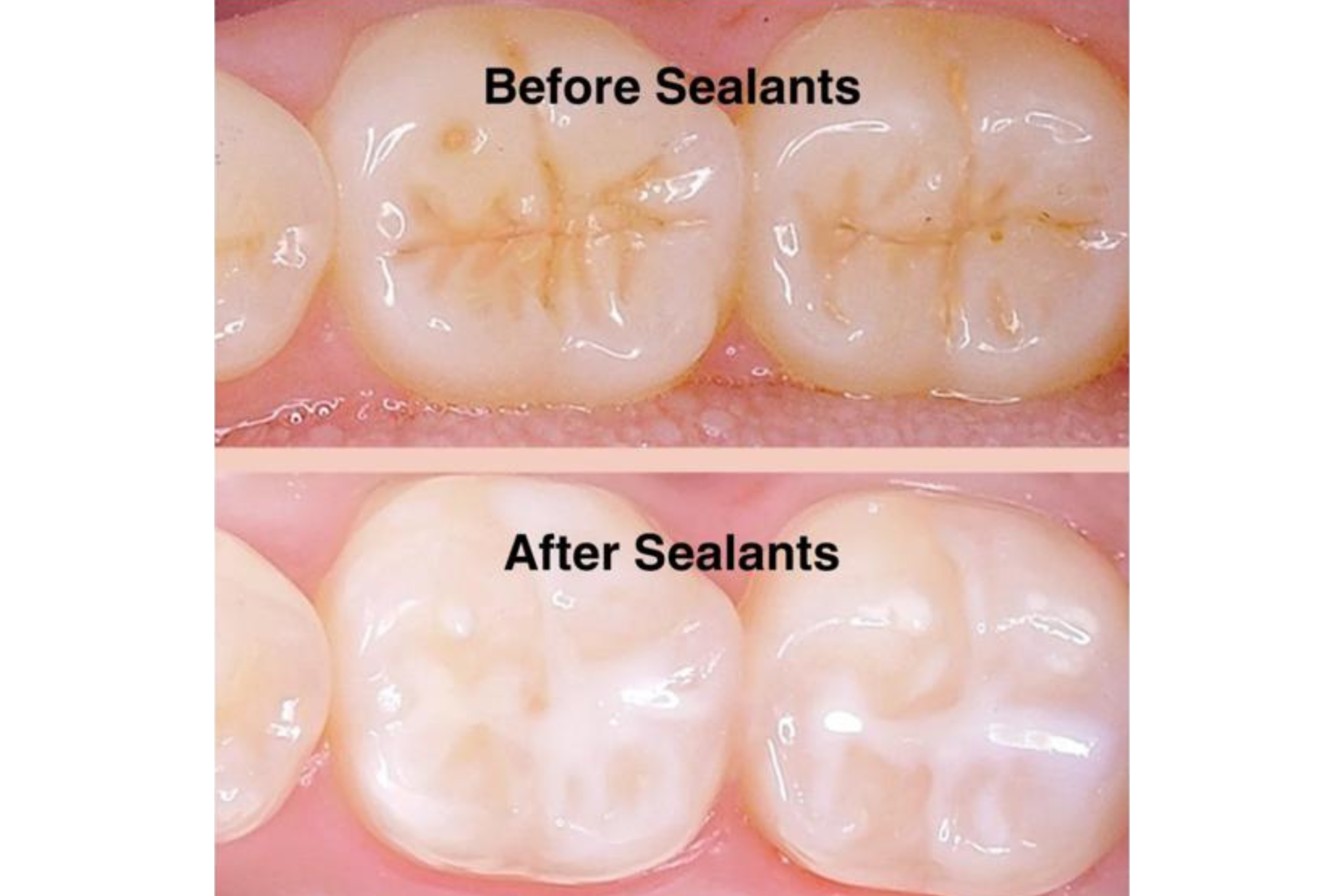 Sealants Sealants